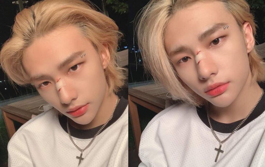 Stray Kids' Hyunjin apparently had jaw surgery