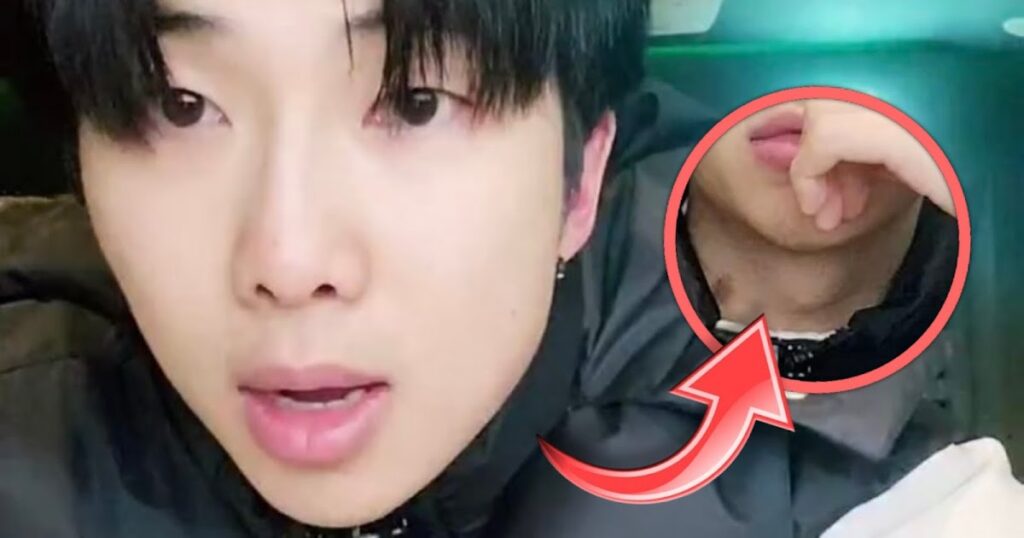 RM of BTS reappears with a big hickey on his neck and drives fans crazy