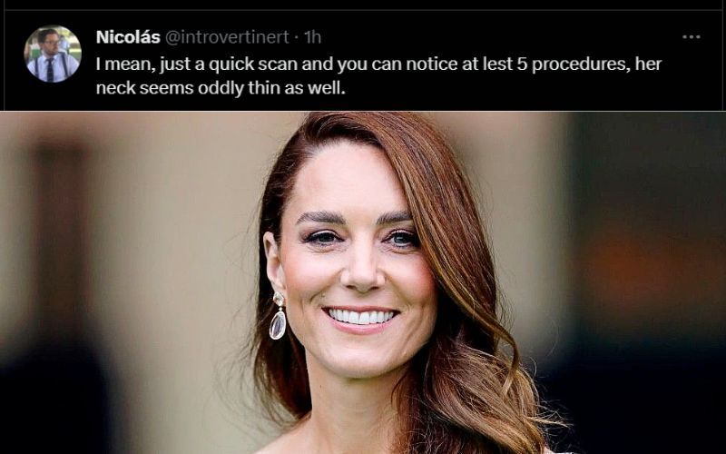 Kate Middleton undergoes surgery to win Prince William back from his mistress