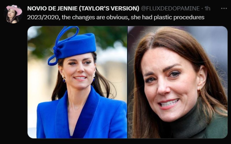 Kate Middleton undergoes surgery to win Prince William back from his mistress