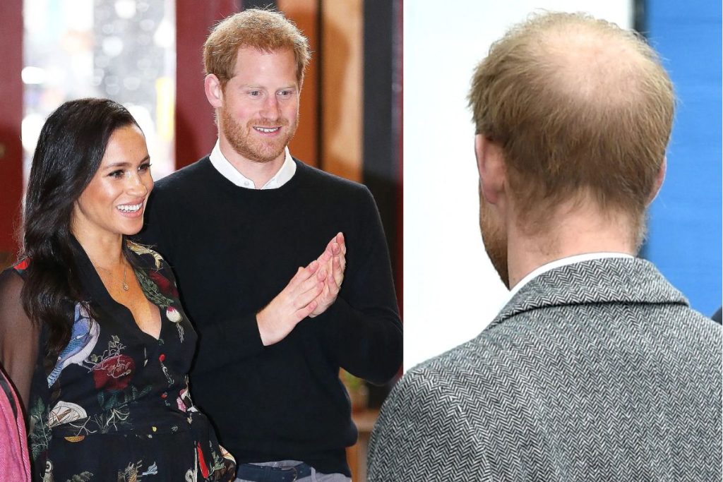Prince Harry tried to implant hair and the result has been worse