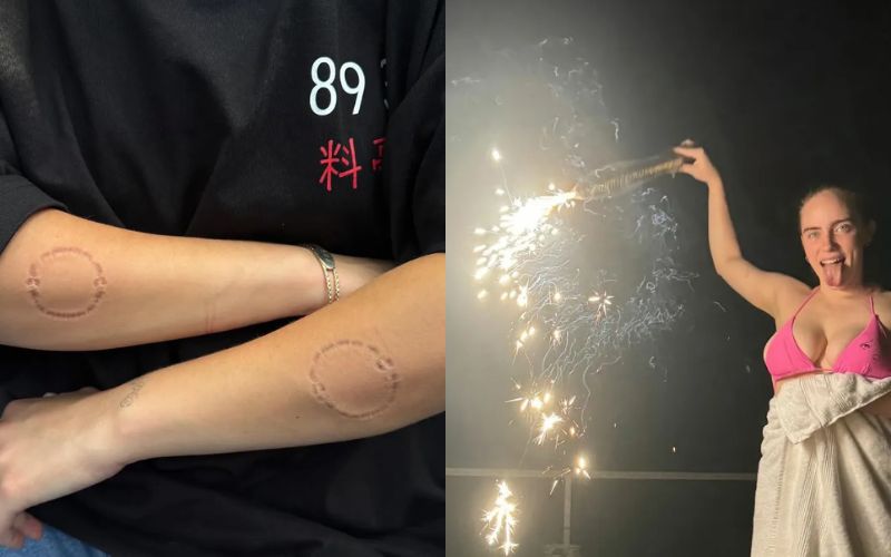 Billie Eilish concerns her fans as she is covered in bite marks and bruises