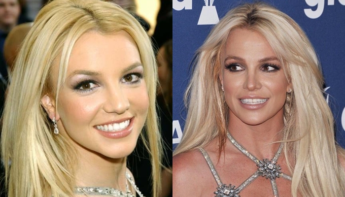 Cirujano plástico analiza el rostro de Britney Spears antes y después