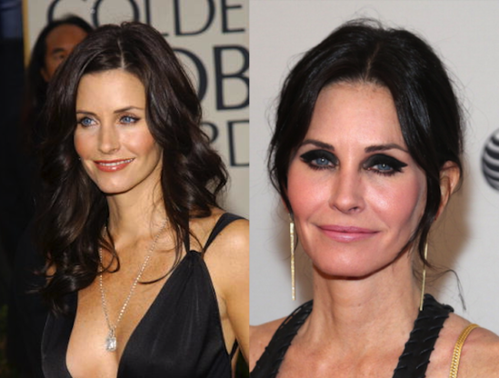 7 celebridades que arruinaron sus rostros con cirugias