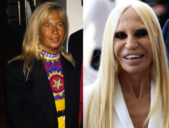 7 celebridades que arruinaron sus rostros con cirugias