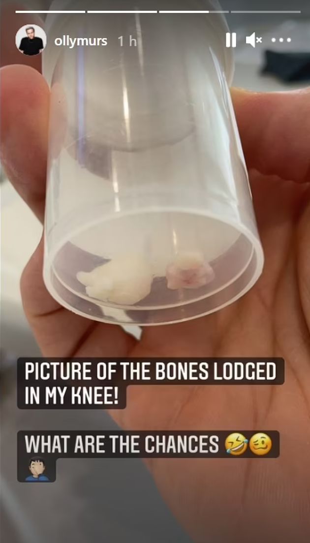 Olly Murs sufre terrible accidente en el escenario que lo llevo directo al hospital