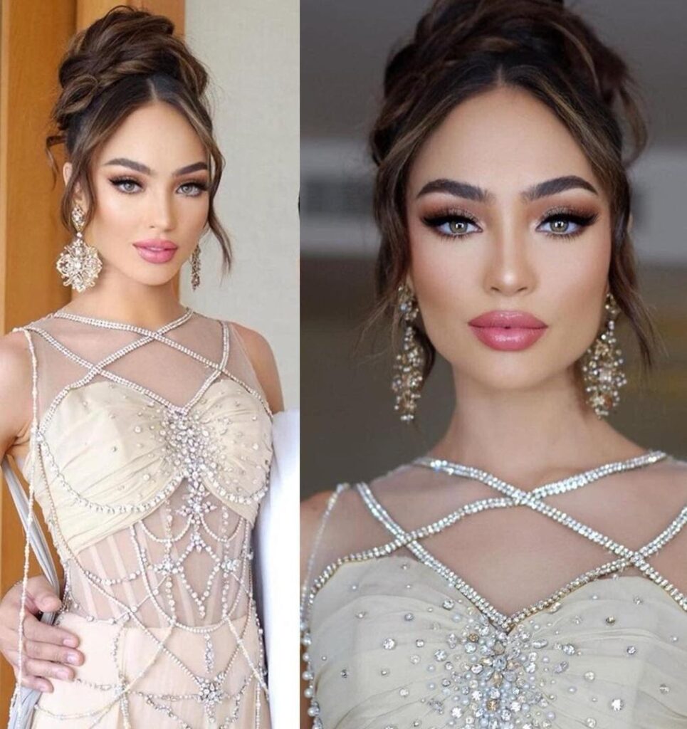 Así luce ahora Miss Universo 2022 tras someterse a un tratamiento de botox