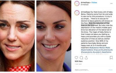 Kate Middleton se inyectó botox en su rostro y el resultado es impresionante